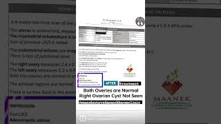 🤗Right Ovarian Cyst size 2.3 cm × 1.9 cm Cured within 4 Months with only Ayurvedic Medicine.✌️🤠