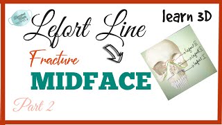 LEFORT LINE 1,2,3 // FRACTURE MIDFACE