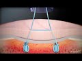 Knotless FiberTak® Soft Anchor: Interconnected Remplissage Technique