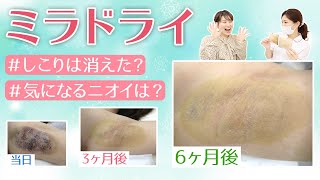 【ワキガ治療 ミラドライ】術後6ヶ月の経過 効果次第では再治療?!果たして結果は...