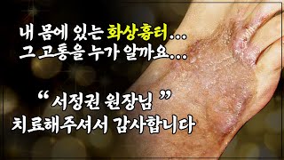 화상 흉터로 인한 우울증을 극복한 감동스토리 - 차트읽어주는남자 12편