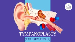 Eardrum Hole Repair Tympanoplasty | How it is done? | After Tympanoplasty  Care | CARE Hospitals