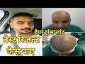 How to Get Best Hair Transplant Results in Hindi By Dr.Rajesh || Why Hair Transplant Fails In Hindi