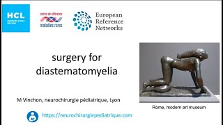 surgery for diastematomyelia