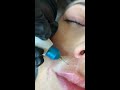 plasma pen fibroblast lip flip