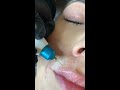 plasma pen fibroblast lip flip