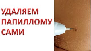 Как пользоваться электро коагулятором чтобы удалить папиллому, гемангиому или родинки самому.