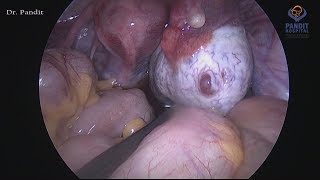 Ovarian Cystectomy With Ovarian Fixation