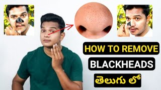 How To Remove Black Heads For Men and Women | Telugu | బ్లాక్ హెడ్స్ ఎలా తొలగించాలి