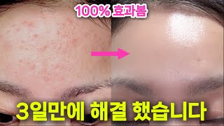 광고❌좁쌀여드름 3일만에 박멸! 지긋지긋한 좁쌀여드름이 고민이라면? 이것부터 바꿔보세요!