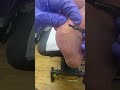 Watch a Podiatrist Remove Corn and Calluses with Ergonx and Docpods for Healthy and Pain-Free Feet