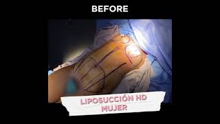 Abdominoplastia + Liposucción HD+ mastopexia con implantes Mujer