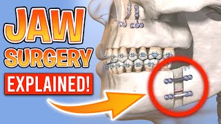 What is Orthognathic Surgery? [Jaw Surgery with Braces Explained]