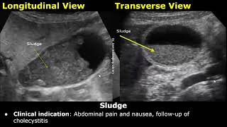 Gallbladder Ultrasound Reporting | GB Disease Scan Reports | How To Write USG Report | Abdominal USG