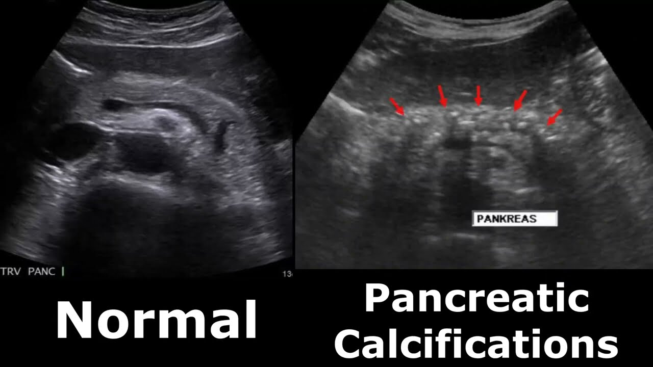 Pancreas Ultrasound Normal Vs Abnormal Appearances Comparison Pancreas ...