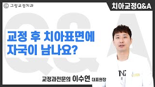 [그랑교정치과]Q. 교정 후 치아표면에 자국이 남거나 색이 변하나요?