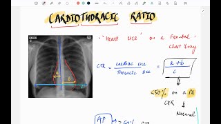 HOW TO ASSESS HEART SIZE ON CHEST X RAY ! CARDIOMEGALY vs NORMAL HEART?