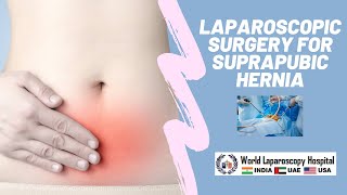 Laparoscopic Management of Suprapubic Incisional  Hernia