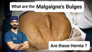 What are Malgaigne's Bulges - Dr Tayyab Riaz Ch