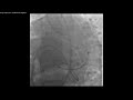 vol.2 issue 3 video 22 coronary artery fistulae indications for treatment and technical...