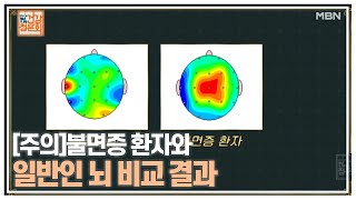 [주의]불면증 환자와 일반인 뇌 비교 결과 MBN 210221 방송