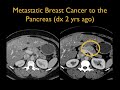 pitfalls and pearls in the ct diagnosis of pancreatic cancer lessons learned