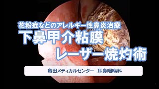 下鼻甲介粘膜レーザー焼灼術【花粉症などのアレルギー性鼻炎治療】