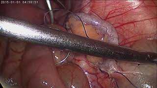 Laparoscopic Interval Appendectomy