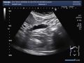 Ultrasound Video showing multiple Polyps in the Gall Bladder.