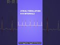 atrial fibrillation vs atrial flutter how they affect the heart