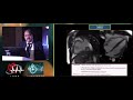 advanced multi modality imaging vt ablation talk by dr. ulhas pandurangi at ihrs 2019