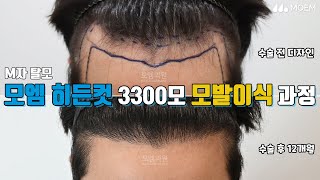 M자 헤어라인모발이식 비절개 히든컷 3300모 전후비교!｜전지훈 원장｜모엠의원(MOEM)