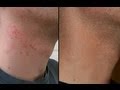HOW TO CURE RAZOR BURN BUMPS ON NECK & LEGS! HOW TO CURE RAZOR BURN BUMPS ON NECK & LEGS!