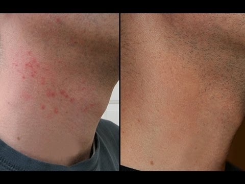 HOW TO CURE RAZOR BURN BUMPS ON NECK & LEGS! HOW TO CURE RAZOR BURN BUMPS ON NECK & LEGS!