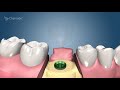 Dental Implant Procedure - Two Stage  🦷  Award Winning Patient Education