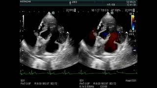 MR at the second degree  AV block of the Wenckebach type