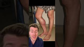 Doctor explains BAKERS CYST in 60 seconds! #shorts #health #medical #doctor