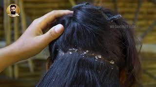 Dandruff Scratching And Homemade Aloe Vera Hair Oil For Dandruff  #36