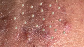 AWESOME BLACKHEADS POPPING | Suri Job 149