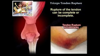 Triceps Tendon Rupture - Everything You Need To Know - Dr. Nabil Ebraheim