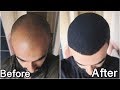 I GREW MY HAIR BACK!! - How I MIRACULOUSLY Reversed My Hair Loss