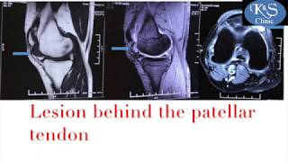 Arthroscopic Tumour Excision