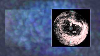 Animation IVUS Catheter in the Ostial RCA