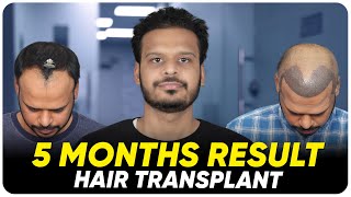 Hair Transplant in Trichy | Best Results \u0026 Cost of Hair Transplant in Trichy