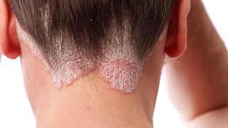 CAUSES OF PSORIASIS IN CHINESE MEDICINE