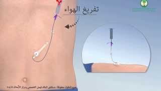 Gastrostomy Feeding Tube أنبوب التغذية (ميكي) عبر جدار البطن