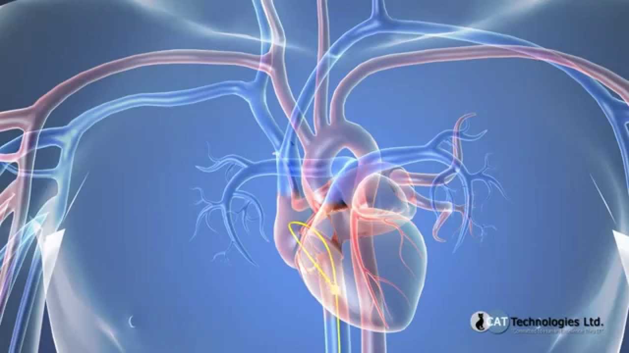 3d Medical Animation Demo Cardiac Catheterization Youtube