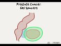 Doctor Explains Prostate Gel Spacer (SpaceOAR)