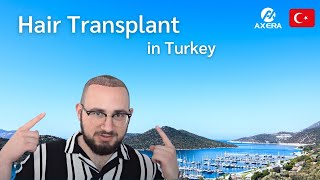 Hair Transplant Journey in Turkey | Testimony by Fahrettin