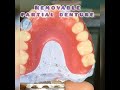 WDC_REMOVABLE PARTIAL DENTURE | PEMASANGAN ANASIR GIGI  #wdc #prosthodontics #dentist#shorts